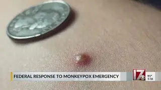 Duke experts talk about monkeypox symptoms