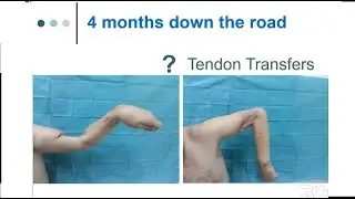 Tendon Transfer Principles: Panagiotis Givissis MD, Aristotle University