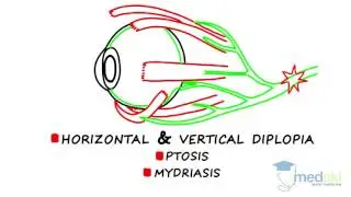 Ophthalmology – Diplopia: By Martin ten Hove M.D.