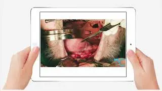 Full Arch Surgery | Dr. Rick Kapitan | Zimmer Biomet Dental