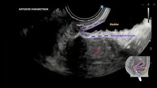 Dynamic transvaginal ultrasound examination for assessing anatomy of parametrium #UOGJournal