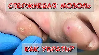 Стержневая мозоль / Мозоль на мизинце / Как убрать мозоль / Педикюр