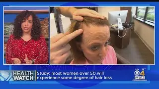 Most Postmenopausal Women Will Experience Hair Loss, Study Suggests