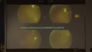 AIOC2022-GP152-Endophthalmitis CIPLA