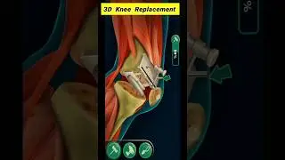 Total Knee Replacement 3D Animation.