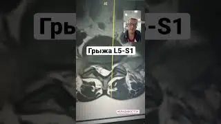 Грыжа L5-S1