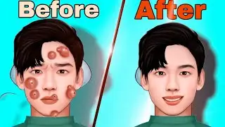 ASMR Face Acne Cleaning | face pimples removal | asmr removal acne | 