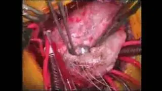 Biventricular Repair