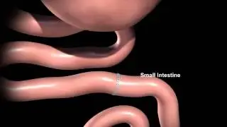 Roux-en-Y Gastric Bypass