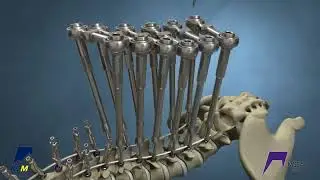 Stryker (K2M): MESA Deformity Product Animation