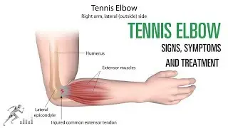 Tennis elbow: Signs and symptoms and treatment of the common elbow injury