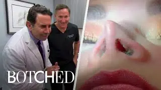 "Botched" Docs Worried About Patient's Thin Nose | E!