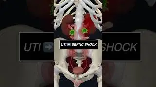 Can you DIE from a UTI?? Doctor Explains!