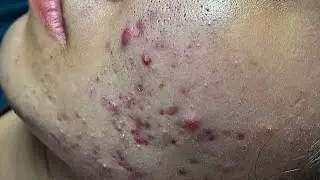 Inflammatory acne, yellow acne, blackheads - Acne Treatments Mai Ngoc 💕💕💕