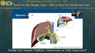 Divide the Hepatic Pedicles: Glissonean or Hilar Approach?