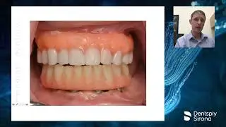 Full-Arch Digital Implant Restorations with Primescan and Atlantis BridgeBase