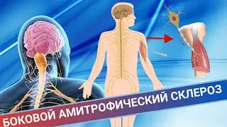 НОГИ ПЕРЕСТАЮТ СЛУШАТЬСЯ || Боковой амиотрофический склероз