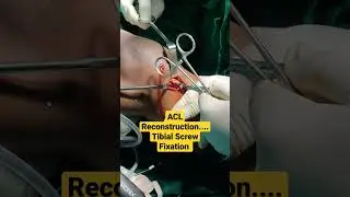 ACL Reconstruction....Tibial Screw Fixation ..Dr Sai Chandra 