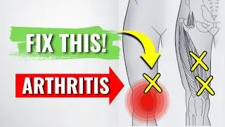 Myofascial Trigger Point Treatment for Knee Arthritis