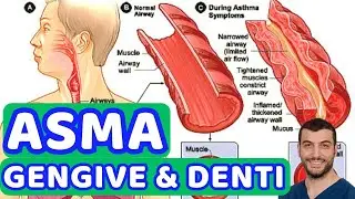 Effetti dell´Asma Bronchiale su Denti e Gengive. 4 consigli per la Prevenzione