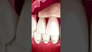 The Surgery To Reveal More Teeth 😨