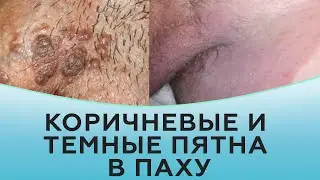 Коричневые и темные пятна в паху