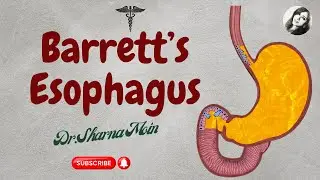 Barretts esophagus