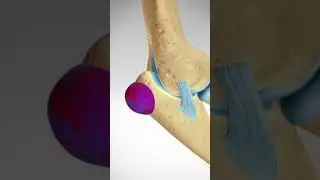 Triceps Tendon Avulsion and Repair 