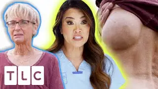 Dr. Lee Removes A Woman’s 12-Year-Old Back Lump | Dr. Pimple Popper: Pop Ups