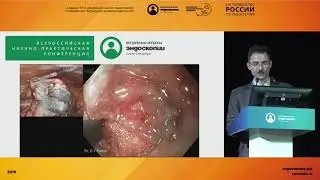 Случай лечения раннего рака желудка комбинированным эндоскопически-лапароскопическим доступом