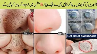 How To Remove BLACKHEADS Permanently From Nose & Face | Instant Whitehead Removal at Home Naturally