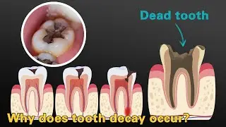 Why does tooth decay occur?