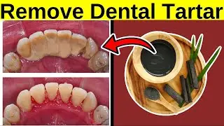 Remove Dental Tartar At Home NATURALLY