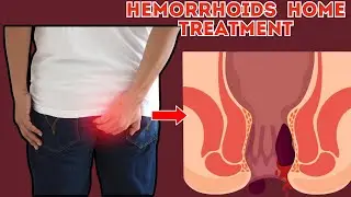 How To Get Rid Of Hemorrhoids Fast | How To Treat Hemorrhoids