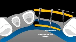 Bone and soft tissue augmentation inspired by Prof. F. Khoury Dr Alex Hong