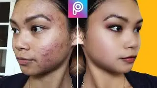 How To Remove Face Pimples In Picsart |Picsart Me Face Smooth Kaise Kare |Picsart Photo Editing