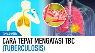 Penanganan TBC Yang Tepat Dan Cepat Berdasarkan Saran Dokter | Kata Dokter