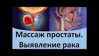 Как можно самому сделать массаж простаты: правила, техники. @Dr.urolog