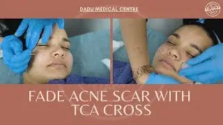 TCA CROSS for acne scarring | TCA Cross treatment for ACNE SCARS