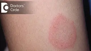 How to manage Chronic Ringworm infection? - Dr. Rajdeep Mysore